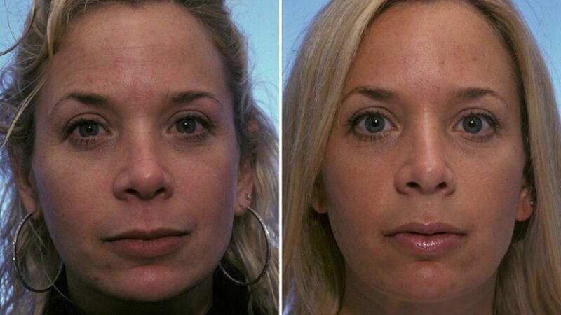 A Comprehensive Guide to Botox Before and After Eyes