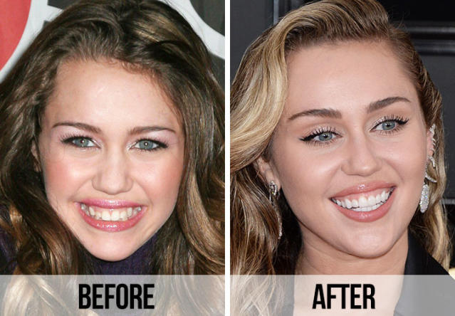 The Transformative Power of   Celebrity   Dental Implants: Stunning Before and After Photos