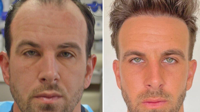 Transform Your Look with   Hair   Transplant Before and After Treatment