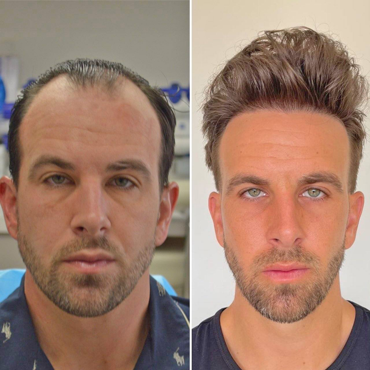 Transform Your Look with   Hair   Transplant Before and After Treatment